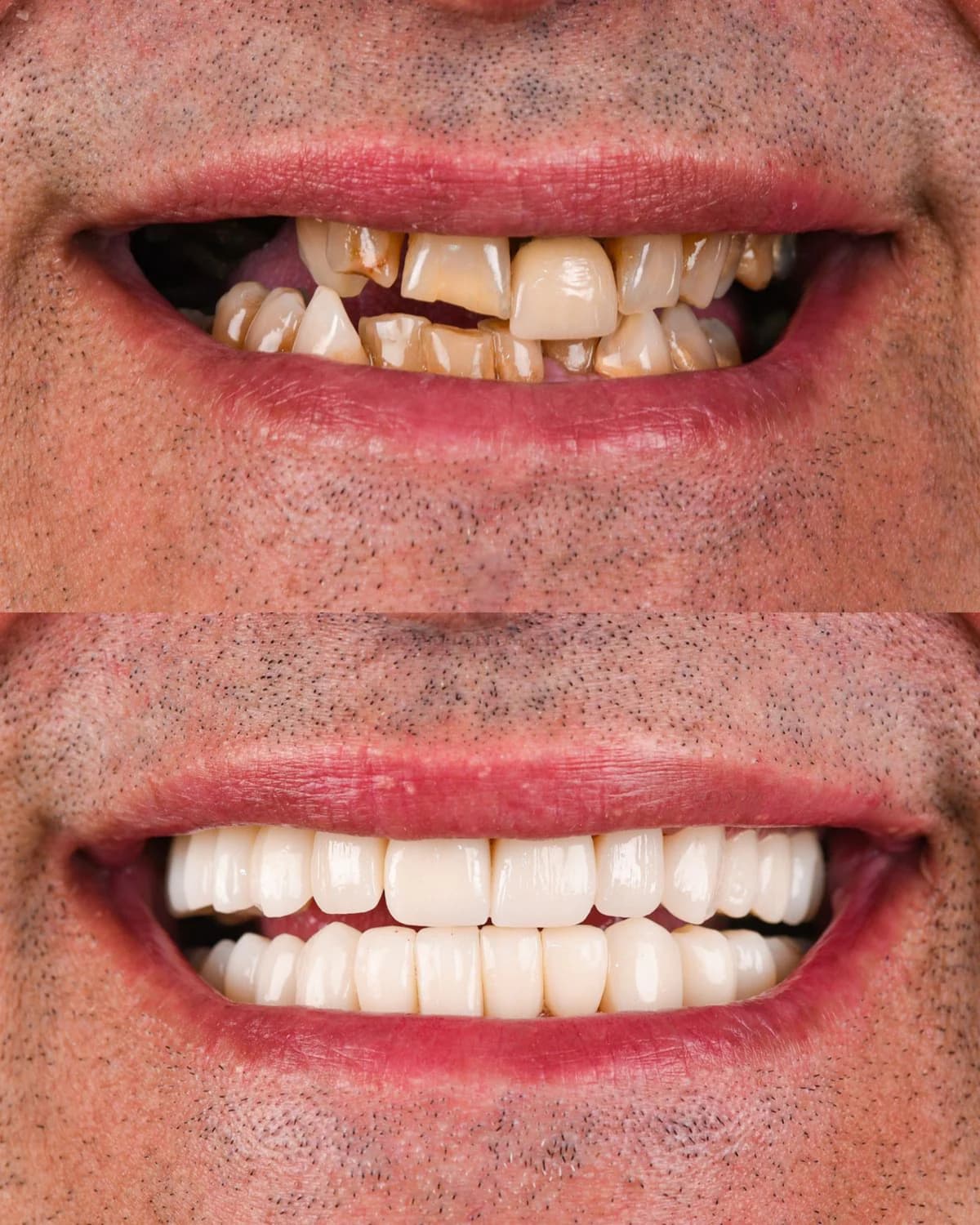 Resultado: Protocolo de reconstrução total de sorriso. (Projeto de Caridade ♡)