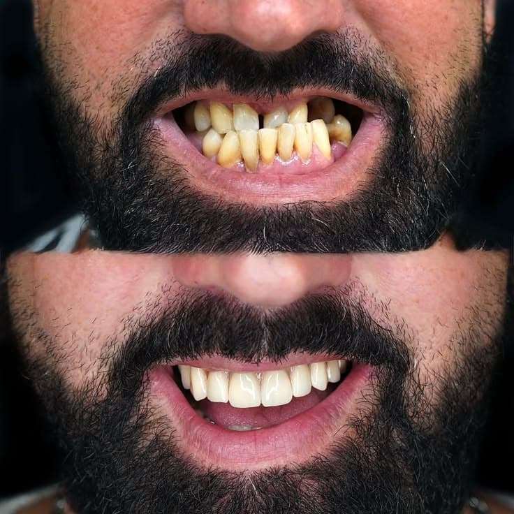 Resultado: Protocolo de reconstrução total de sorriso. (Projeto de Caridade ♡)